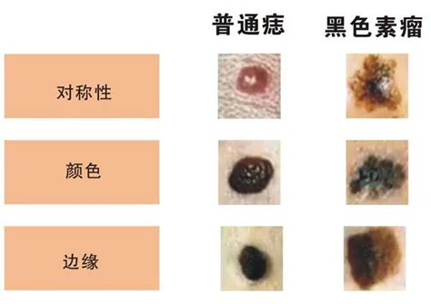 身體長黑痣|是痣還是瘤？黑色素瘤的類型、症狀與治療